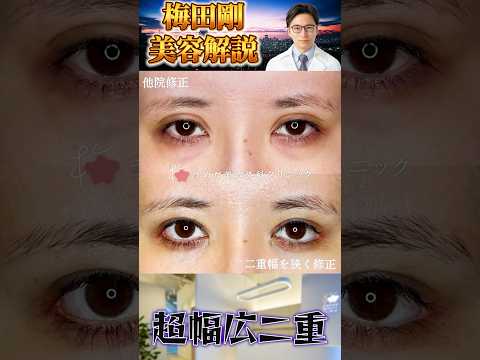 医学科 ハム目の他院修正　#うめだ美容外科クリニック #美容外科 #眼瞼下垂