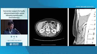 제18회 서울아산병원 외과 연수강좌 : Conversion surgery for locally advanced pancreatic cancer following neoadjuvant chemotherapy 미리보기