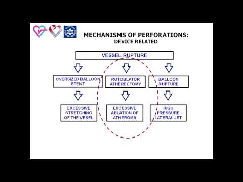 CORONARY PERFORATION: PART 2. MECHANISMS, SCENARIO & SITE