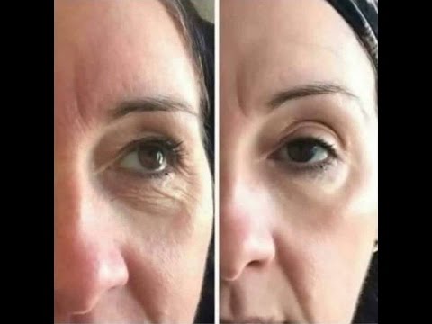 Steroid untuk membakar lemak pada anak perempuan Tipis untuk menghilangkan kerutan di bawah mata