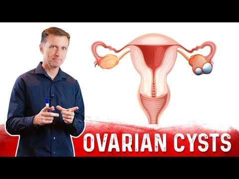 Ovarian Cysts: Causes, Symptoms & Natural Treatment – Dr.Berg