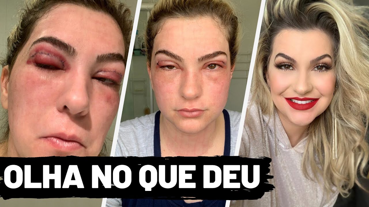 TUDO SOBRE MINHA BLEFAROPLASTIA (TIREI AS BOLSAS E PELANCAS DOS OLHOS) POR ALICE SALAZAR