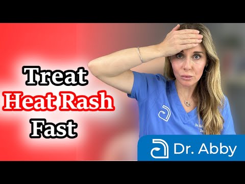 How to identify and treat heat rash fast