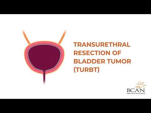 Video: What is a TURBT? – Bladder Cancer Advocacy Network