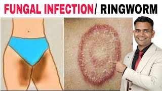 Get Rid Of Ringworm Naturally | Fix Fungal Infection Naturally - Dr. Vivek Joshi