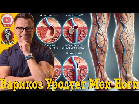 Варикоз уродует мои ноги! Варикоз уродует мои ноги!