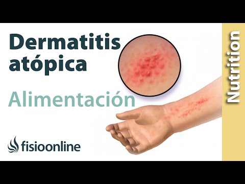 Importancia de la nutrición en el desarrollo en la dermatitis atópica
