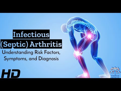 Decoding Infectious Arthritis: Unraveling Risk Factors, Symptoms, and Diagnostics