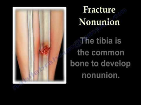 NONUNION OF FRACTURES CAUSES AND TREATMENT - Everything You Need To Know - Dr. Nabil Ebraheim