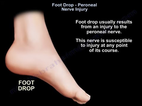 Comprender la caída del pie: causas, síntomas y tratamiento de la lesión del nervio peroneo