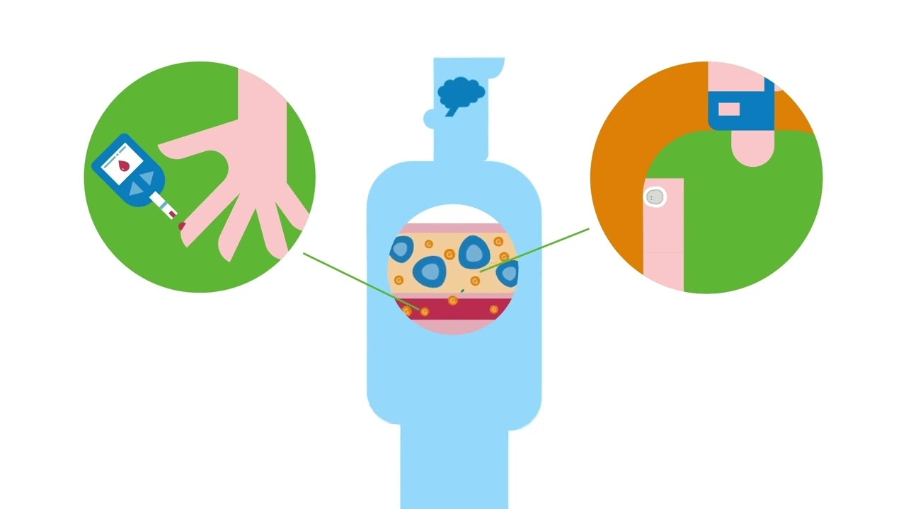 실시간(real-time) CGM 소개