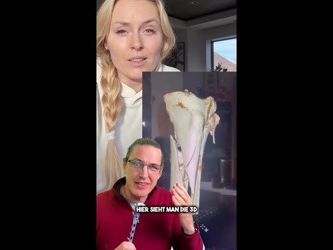 Lindsey Vonn: Diese Komplikation hätte ihr Bein kosten können