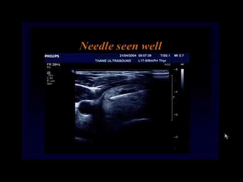 Ultrasound Guided Interventions