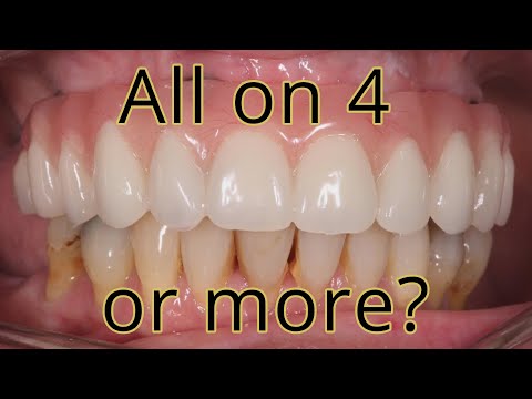 All on 4 or All on 6 or more?