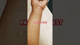 Part 1 TB Test #CVSMinuteClinic #TBTest #PartOne