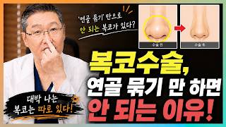 복코수술, ‘연골 묶기’만 하면 안 …