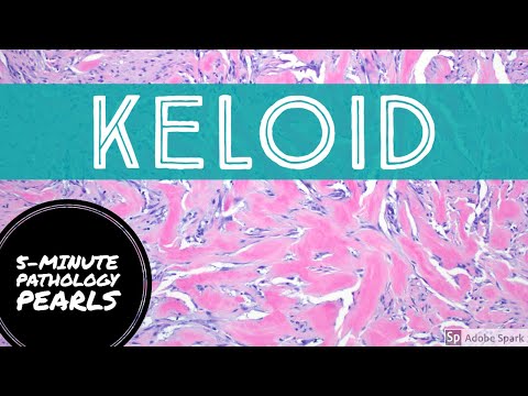 Keloid Scar: 5-Minute Pathology Pearls