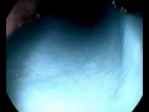 Laserlithotripsie bei einem großen Blasenstein