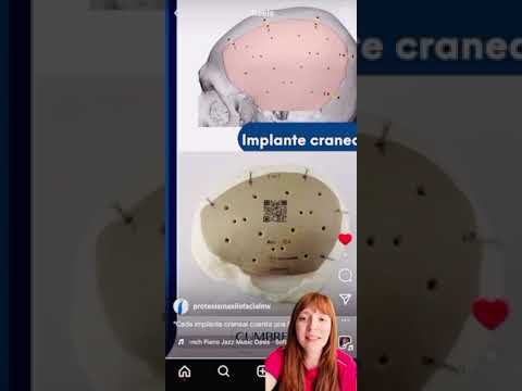 Prótesis Craneal 💀