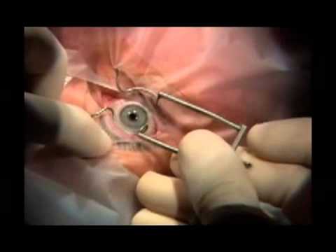 Operación de miopía con láser, ¿cómo es? Operación de miopía con láser, ¿cómo es?