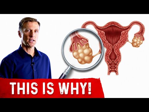 Why Did I Get PCOS (Polycystic Ovarian Syndrome)?