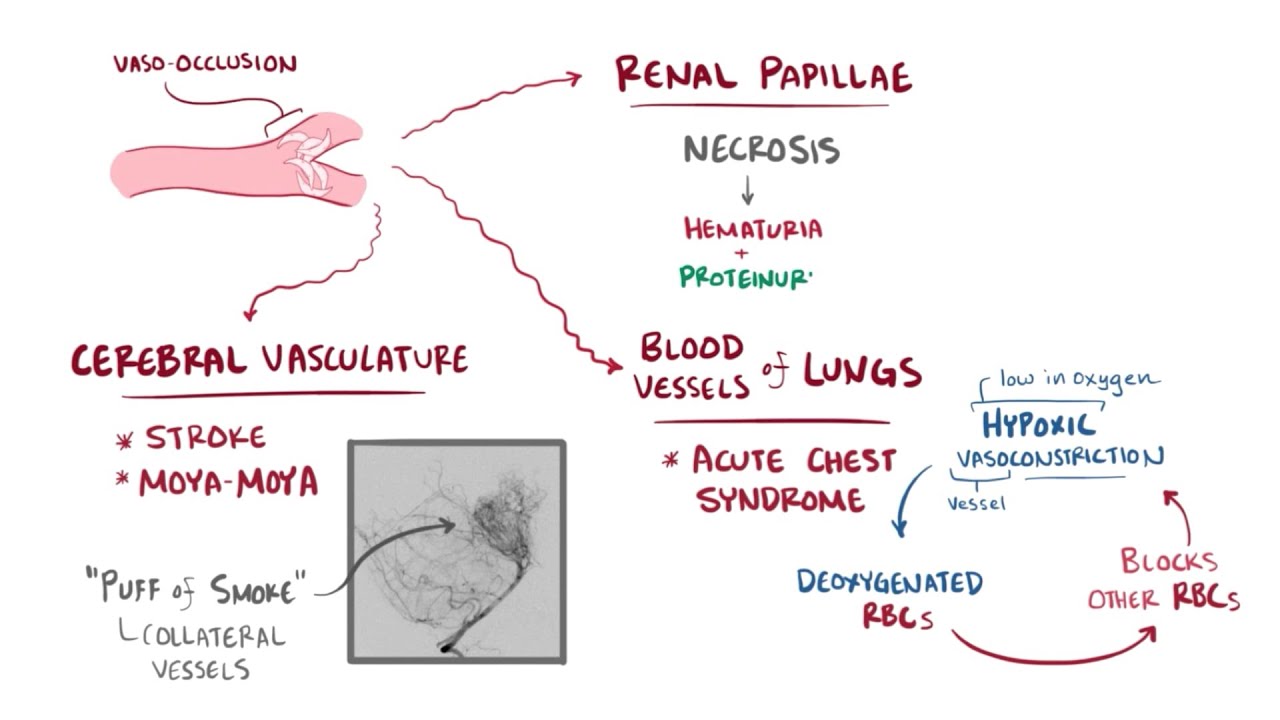 Understanding Sickle Cell Disease