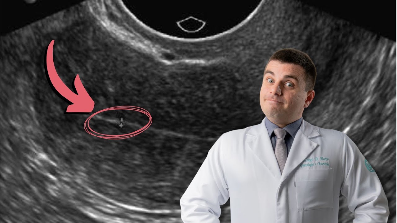 HIPERPLASIA endometrial: Sintomas, Causas e Tratamentos.