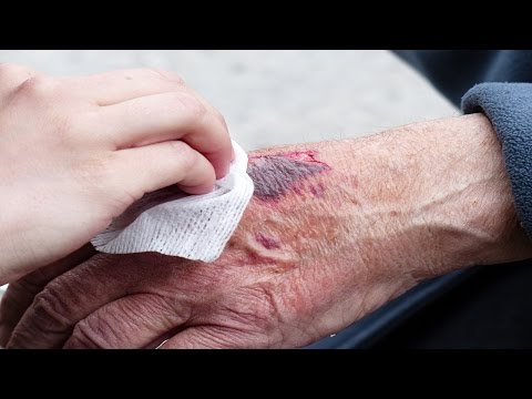 Arthritischen Knöchel Synovitis Stark verletzt die rechte Seite des Rückens