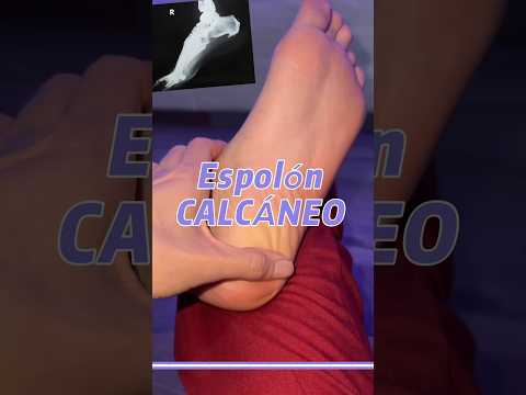 ¿Te duele el talón? 🥲 podrías tener un espolón calcáneo #talon #espolon #dolor