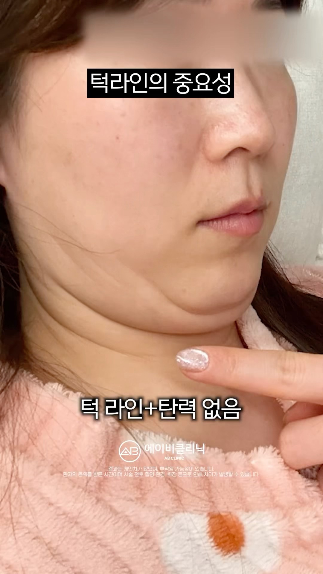 턱라인의 중요성❗