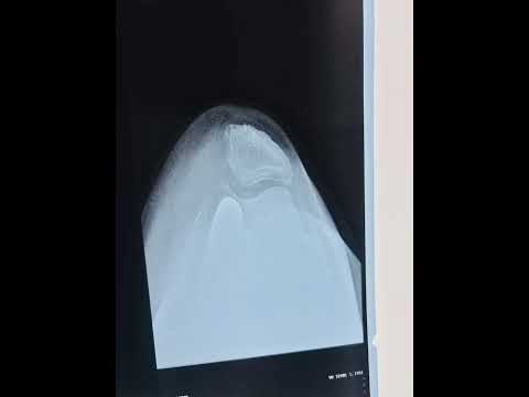 Happy Cross-Leg Sitting After Robotic Knee | Dr. Nakul Shah 