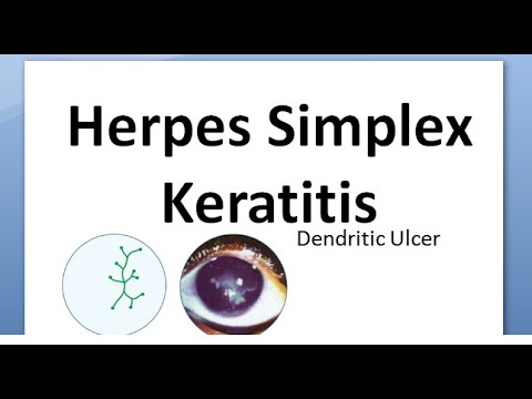 Ophthalmology 116 Herpes Simplex Keratitis Virus Cornea Dendritic HSV Wessley NeuroTrophic Disciform - YouTube