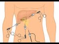 Cholecystectomy | Gallbladder Removal Surgery