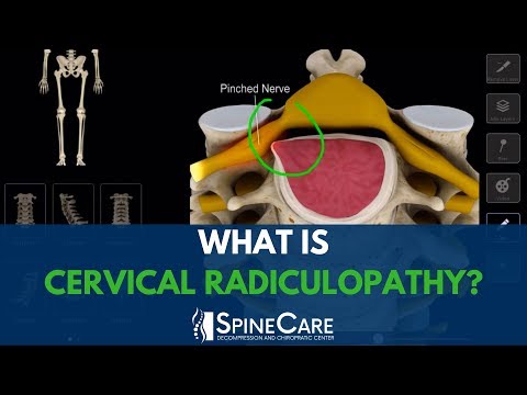 What is Cervical Radiculopathy?