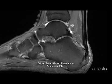 Fersenschmerz - Fußspezialistin Dr. Galla