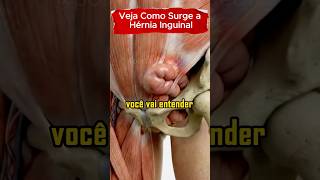 COMO SURGE A HÉRNIA INGUINAL #saude #saudavel #herniainguinal #cirugiageneral #intestino #hernias