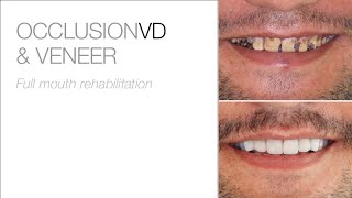 Full Mouth Rehabilitation with edelweiss VENEERs and OCCLUSION-VDs