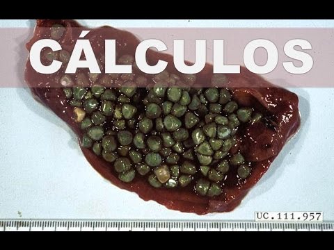 Remedios caseros para los cálculos biliares