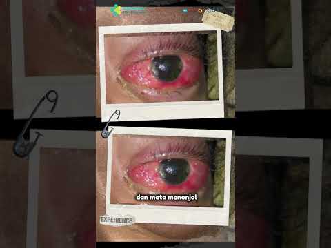 Mengenal Retinoblastoma