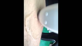 P-808 diode laser hair removal machine test.