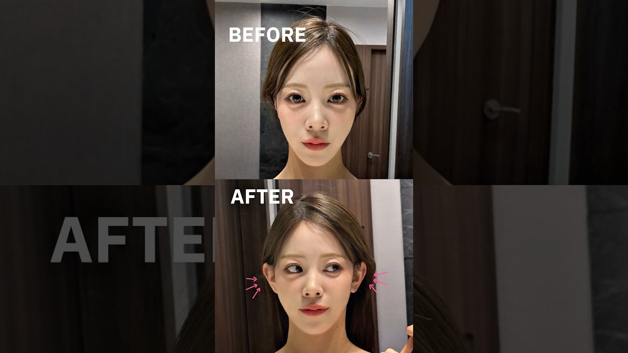 立ち耳フィラーで小顔+中顔面短縮 #shorts #ギリン美容外科 #韓国美容