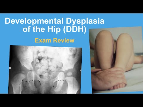 Developmental Dysplasia of the Hip Exam Review - Ernie Sink, MD