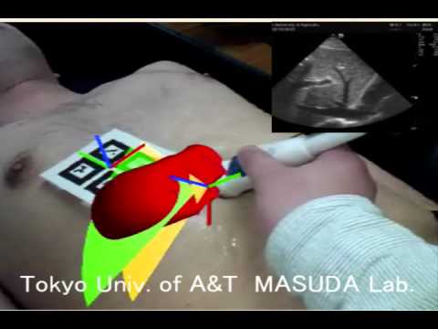 3D body mark using AR technology