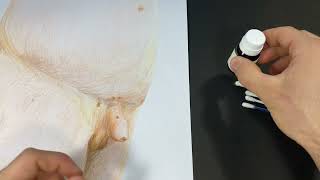 Cómo usar los productos para eliminar verrugas | TRATAMIENTO del VPH