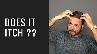 Hair Replacement Hair System Review Does it Itch?