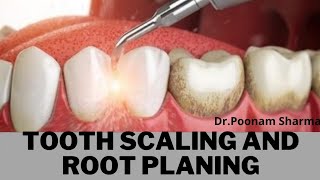 What is Dental Scaling and Root Planing? When is Dental Scaling and Root Planing Necessary (English)