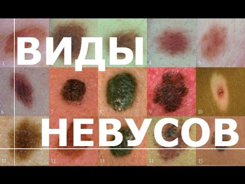 Маска с аскорутином для лица от пигментных пятен на лице Пигментные пятна на грудине у женщин