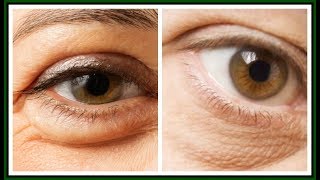 5 WAYS TO GET RID OF PUFFY EYES |SIMPLE HOME REMEDIES FOR PUFFY EYES |Khichi Beauty
