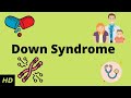 Down Syndrome, Causes, Signs and Symptoms, Diagnosis and Treatment.