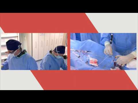 Acrostak ACROSS CTO, ACROSS HP, & M-CATH - RCA CTO